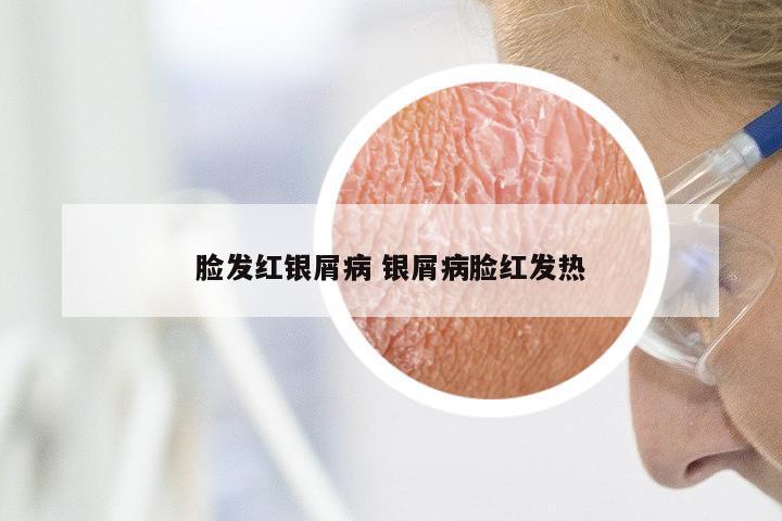 脸发红银屑病 银屑病脸红发热