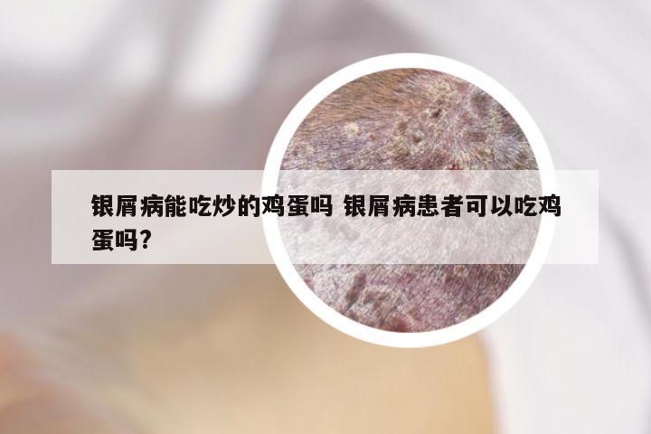 银屑病能吃炒的鸡蛋吗 银屑病患者可以吃鸡蛋吗?
