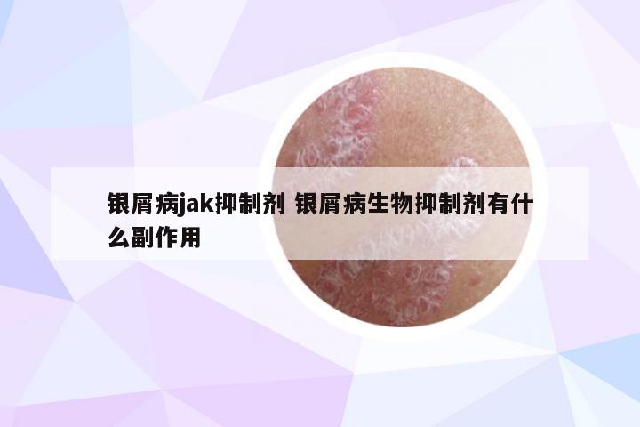 银屑病jak抑制剂 银屑病生物抑制剂有什么副作用