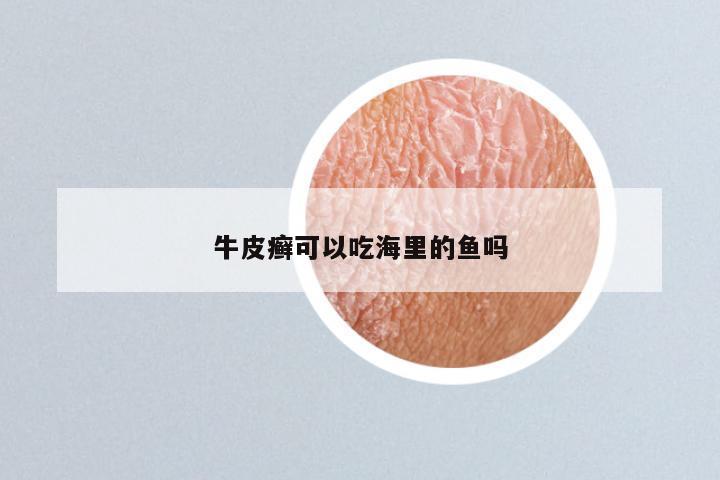 牛皮癣可以吃海里的鱼吗