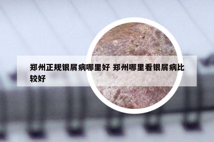 郑州正规银屑病哪里好 郑州哪里看银屑病比较好
