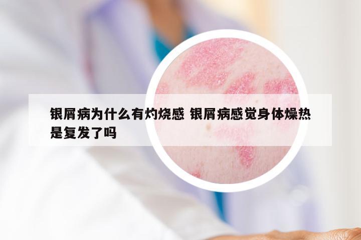 银屑病为什么有灼烧感 银屑病感觉身体燥热是复发了吗