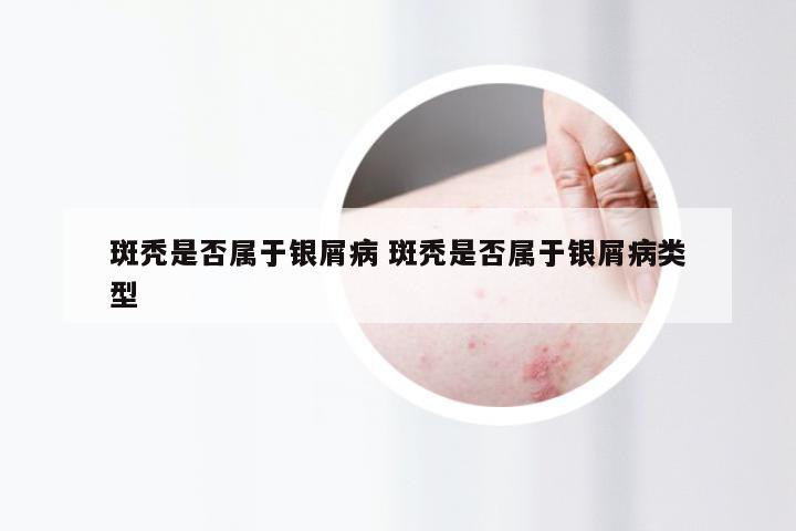 斑秃是否属于银屑病 斑秃是否属于银屑病类型