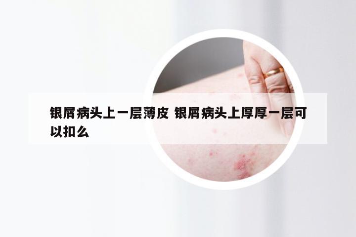 银屑病头上一层薄皮 银屑病头上厚厚一层可以扣么