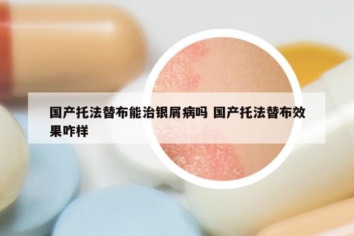 国产托法替布能治银屑病吗 国产托法替布效果咋样