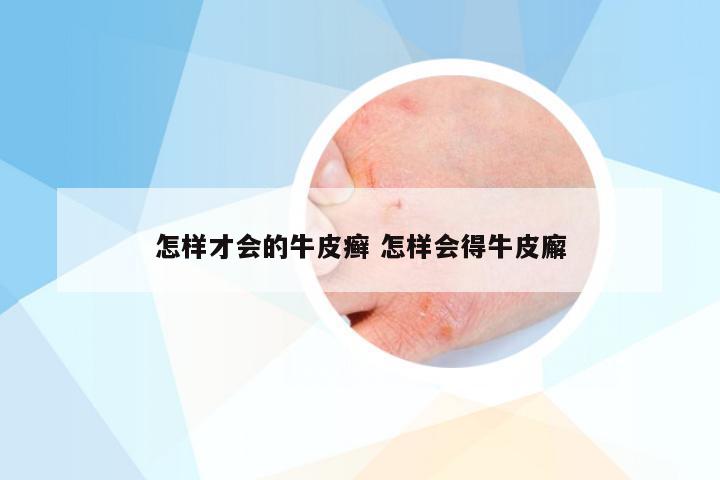 怎样才会的牛皮癣 怎样会得牛皮廨