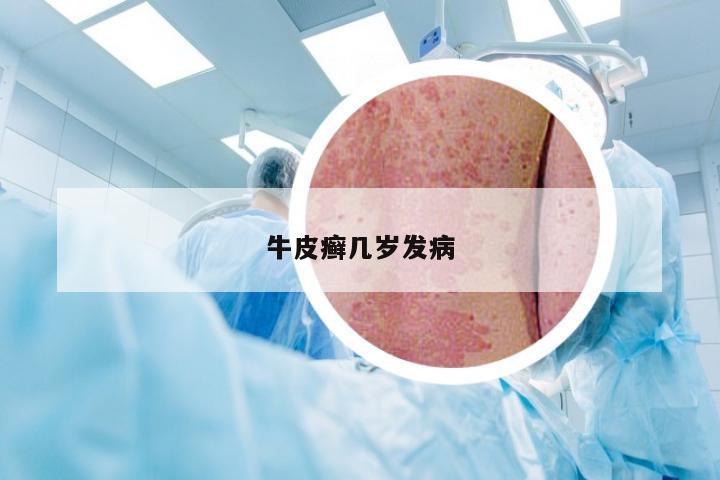 牛皮癣几岁发病