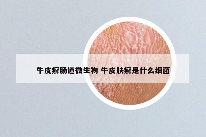 牛皮癣肠道微生物 牛皮肤癣是什么细菌