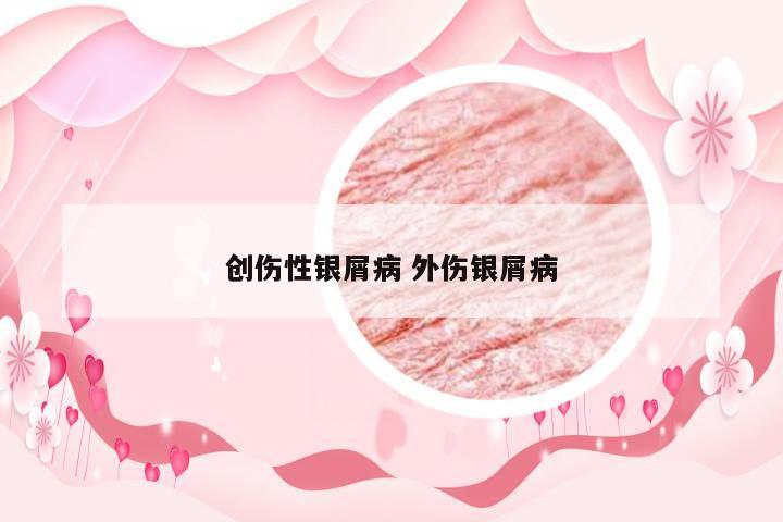 创伤性银屑病 外伤银屑病