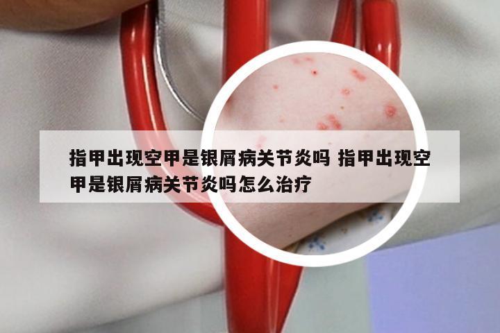 指甲出现空甲是银屑病关节炎吗 指甲出现空甲是银屑病关节炎吗怎么治疗