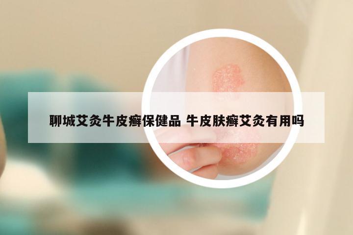 聊城艾灸牛皮癣保健品 牛皮肤癣艾灸有用吗