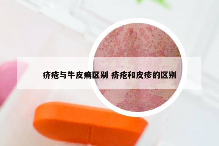 疥疮与牛皮癣区别 疥疮和皮疹的区别