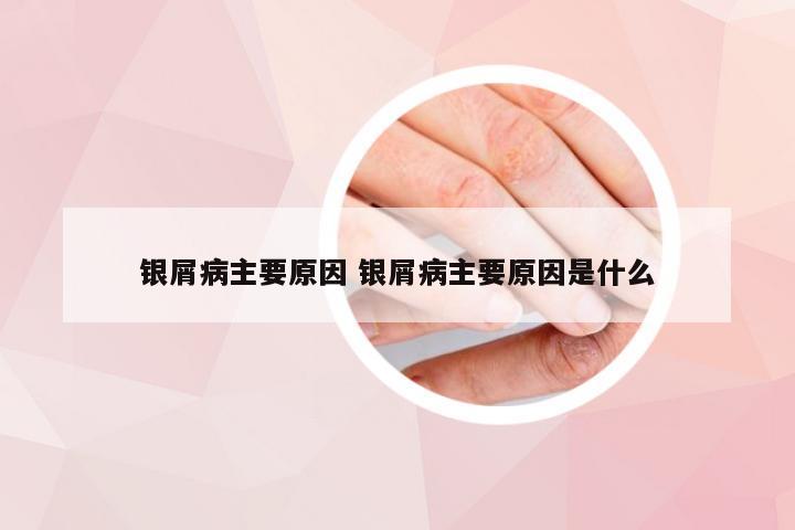 银屑病主要原因 银屑病主要原因是什么