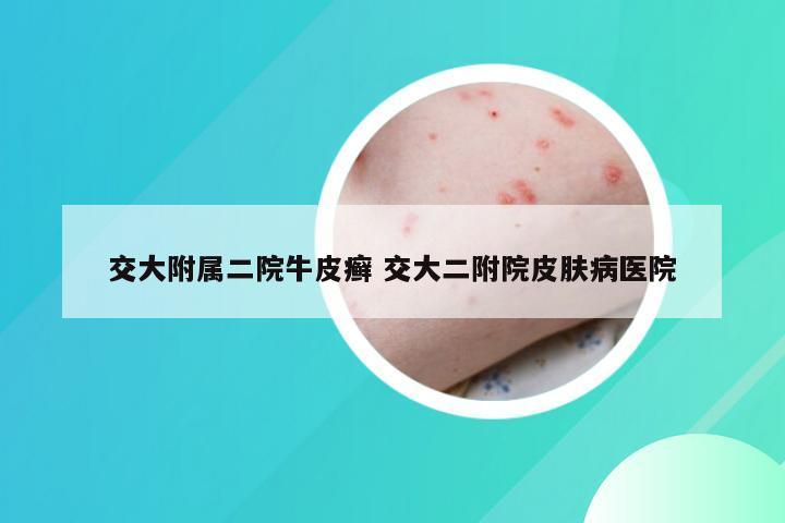 交大附属二院牛皮癣 交大二附院皮肤病医院