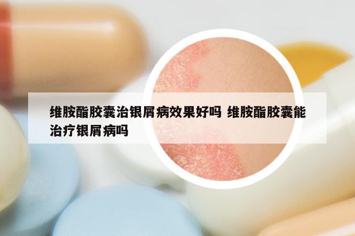 维胺酯胶囊治银屑病效果好吗 维胺酯胶囊能治疗银屑病吗