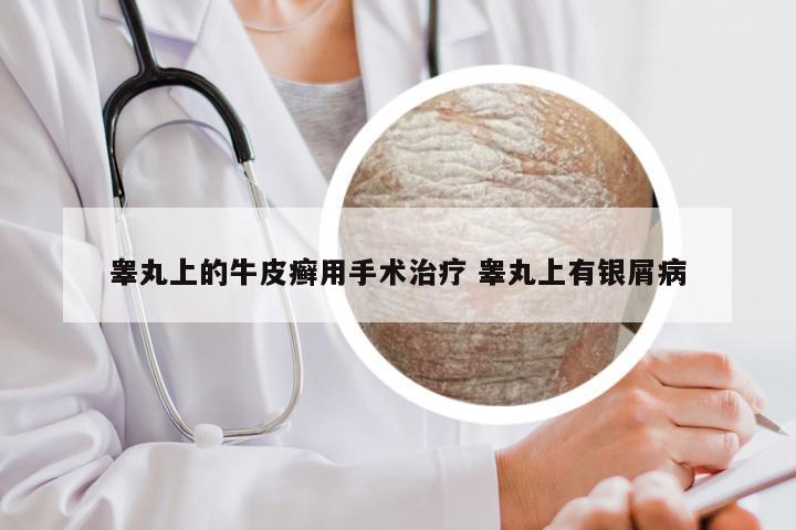 睾丸上的牛皮癣用手术治疗 睾丸上有银屑病