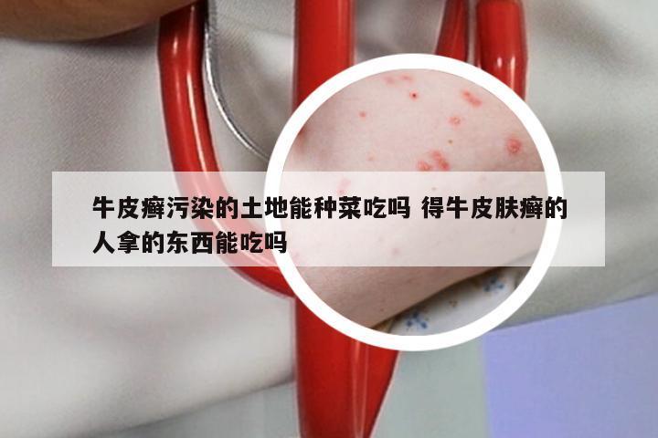 牛皮癣污染的土地能种菜吃吗 得牛皮肤癣的人拿的东西能吃吗