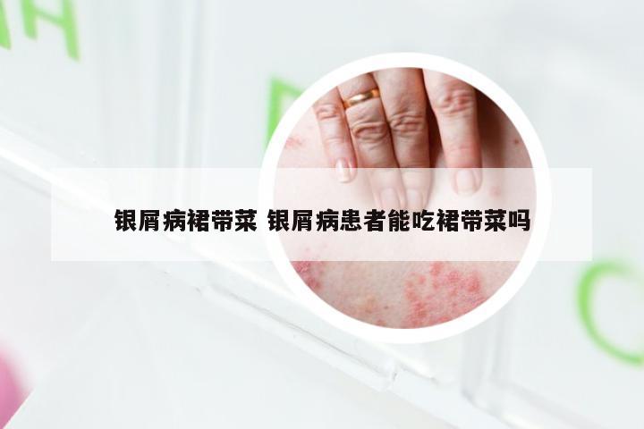 银屑病裙带菜 银屑病患者能吃裙带菜吗