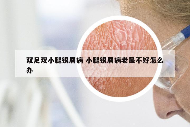 双足双小腿银屑病 小腿银屑病老是不好怎么办