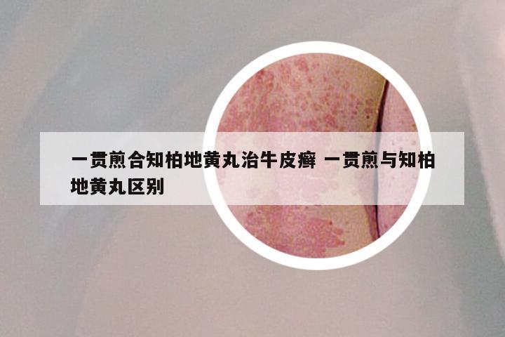 一贯煎合知柏地黄丸治牛皮癣 一贯煎与知柏地黄丸区别