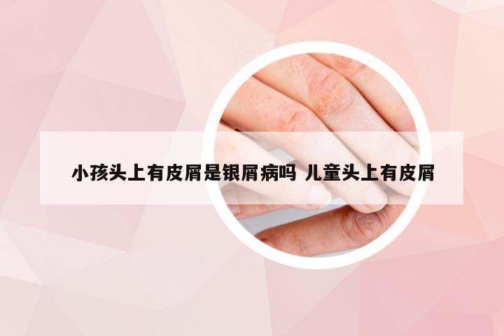 小孩头上有皮屑是银屑病吗 儿童头上有皮屑