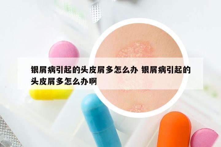 银屑病引起的头皮屑多怎么办 银屑病引起的头皮屑多怎么办啊