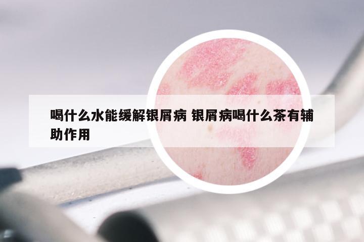 喝什么水能缓解银屑病 银屑病喝什么茶有辅助作用