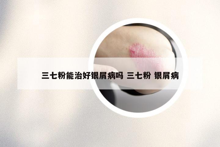 三七粉能治好银屑病吗 三七粉 银屑病