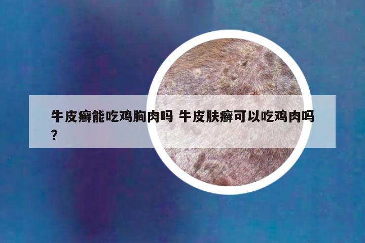 牛皮癣能吃鸡胸肉吗 牛皮肤癣可以吃鸡肉吗?