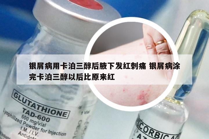 银屑病用卡泊三醇后腋下发红刺痛 银屑病涂完卡泊三醇以后比原来红