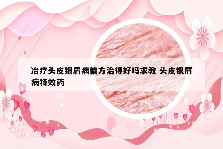 冶疗头皮银屑病偏方治得好吗求教 头皮银屑病特效药