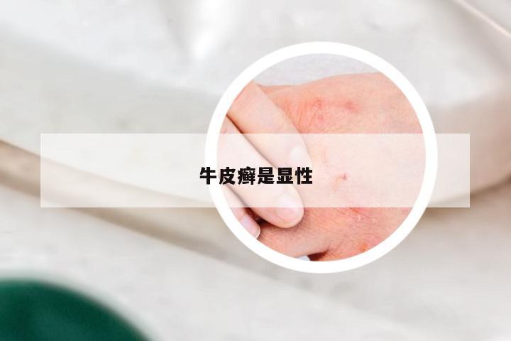牛皮癣是显性