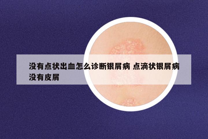 没有点状出血怎么诊断银屑病 点滴状银屑病没有皮屑