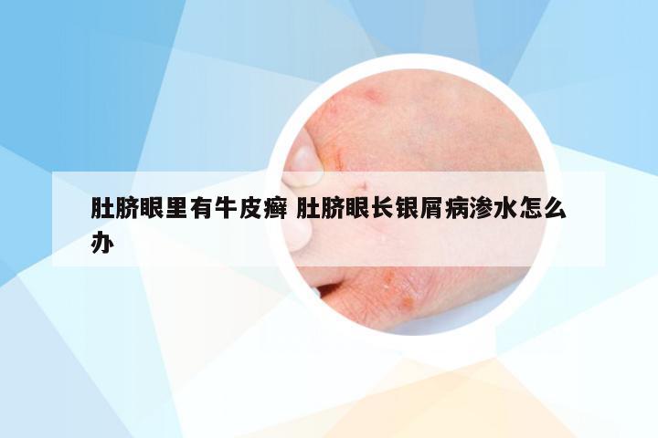 肚脐眼里有牛皮癣 肚脐眼长银屑病渗水怎么办