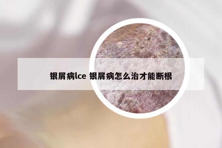银屑病lce 银屑病怎么治才能断根