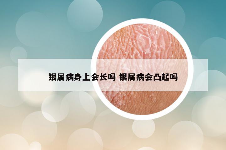 银屑病身上会长吗 银屑病会凸起吗