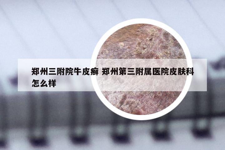 郑州三附院牛皮癣 郑州第三附属医院皮肤科怎么样