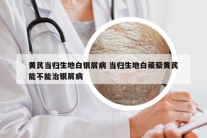 黄芪当归生地白银屑病 当归生地白蒺藜黄芪能不能治银屑病