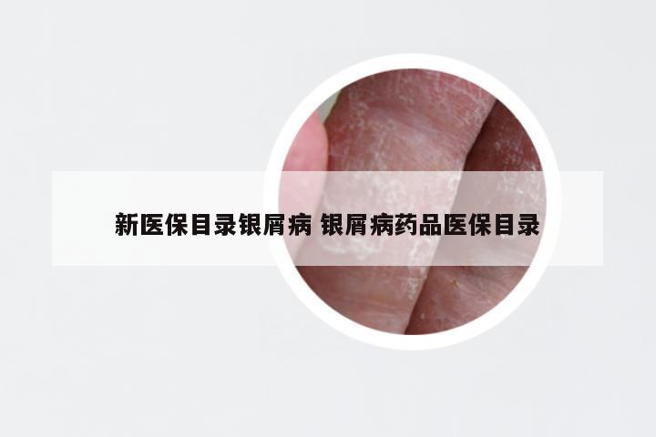 新医保目录银屑病 银屑病药品医保目录