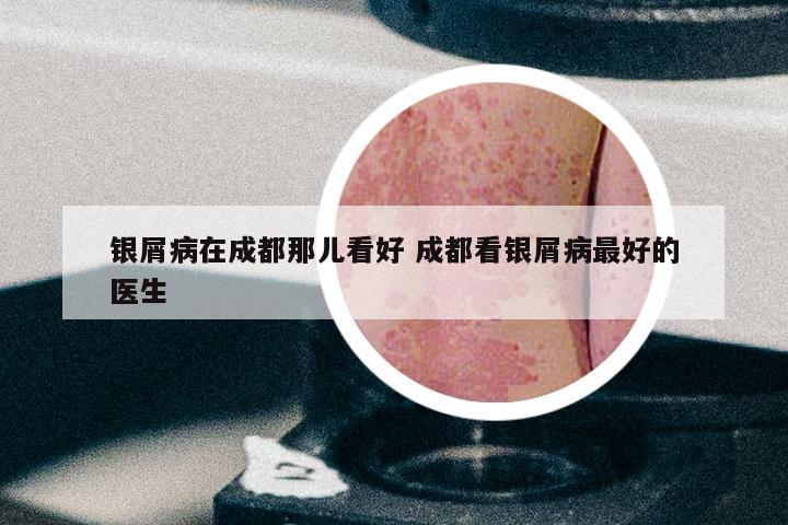 银屑病在成都那儿看好 成都看银屑病最好的医生