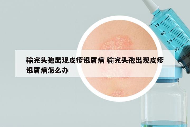 输完头孢出现皮疹银屑病 输完头孢出现皮疹银屑病怎么办