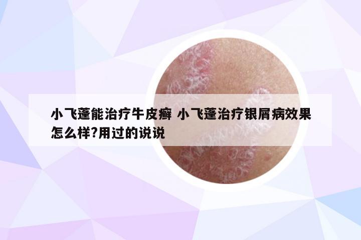 小飞蓬能治疗牛皮癣 小飞蓬治疗银屑病效果怎么样?用过的说说