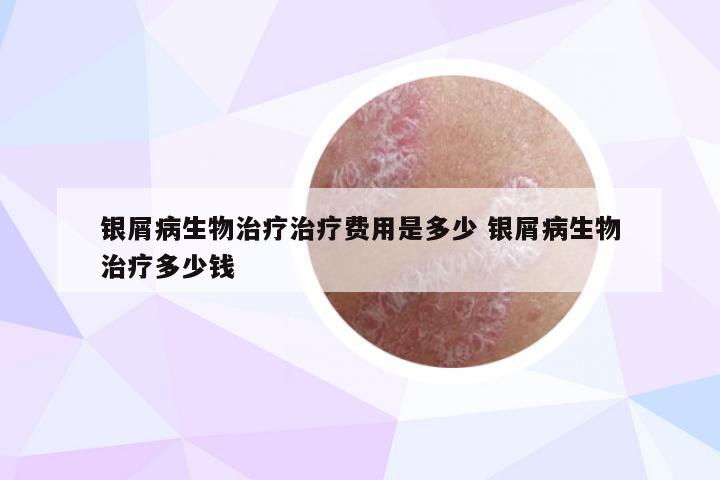 银屑病生物治疗治疗费用是多少 银屑病生物治疗多少钱