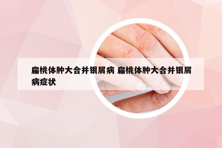 扁桃体肿大合并银屑病 扁桃体肿大合并银屑病症状