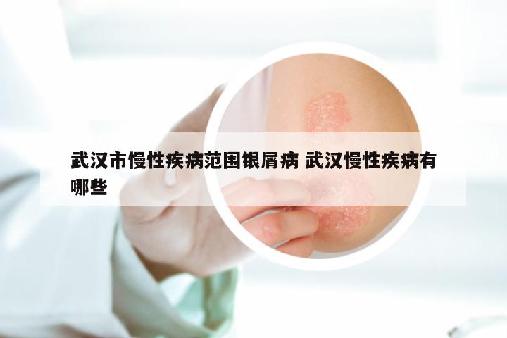 武汉市慢性疾病范围银屑病 武汉慢性疾病有哪些