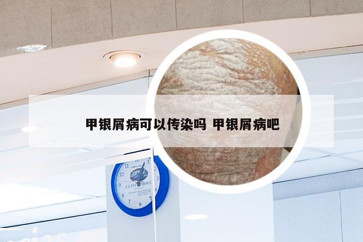 甲银屑病可以传染吗 甲银屑病吧