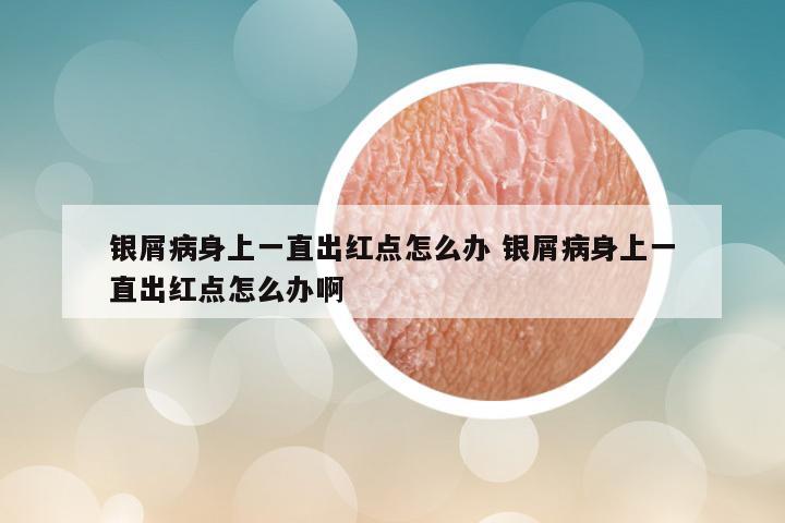 银屑病身上一直出红点怎么办 银屑病身上一直出红点怎么办啊