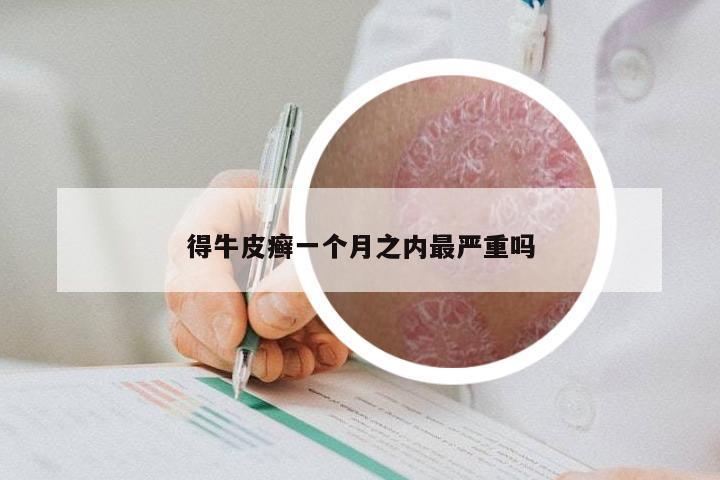 得牛皮癣一个月之内最严重吗