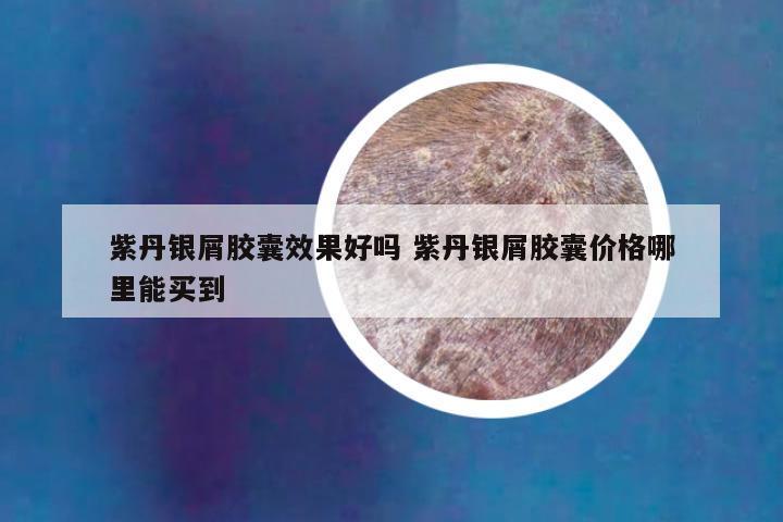 紫丹银屑胶囊效果好吗 紫丹银屑胶囊价格哪里能买到