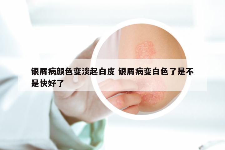 银屑病颜色变淡起白皮 银屑病变白色了是不是快好了